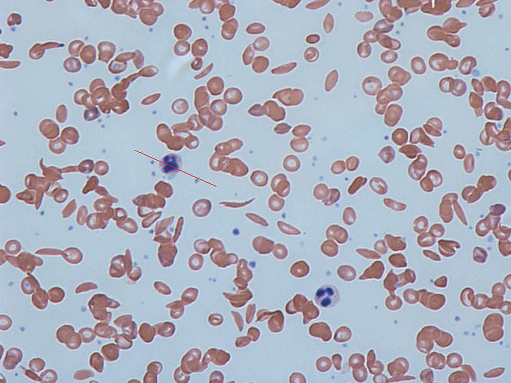 NEJM: world's first successful gene therapy clinical trial for sickle cell disease