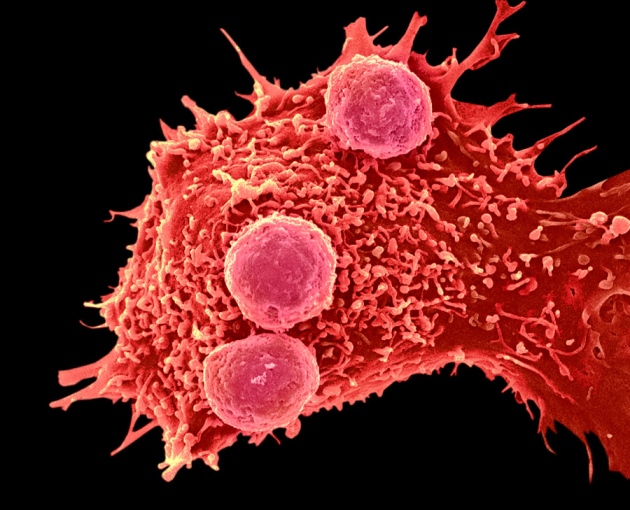 First in the U.S.: CRISPR gene editing applied to cancer treatment